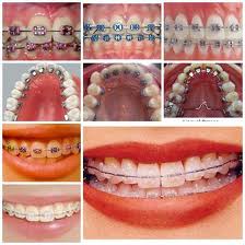 Ortodonti Nedir?