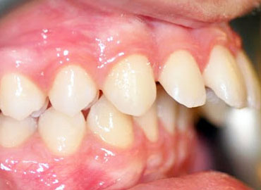 Ortodontik Anomaliler
